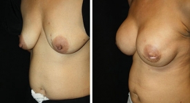 breast-reconstruction_p1