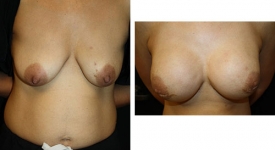 breast-reconstruction_p3