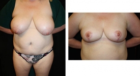 breast-reduction_p1