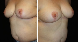 breast-reduction_p2