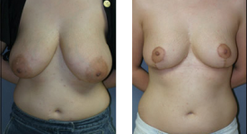 breast_reduction_p2