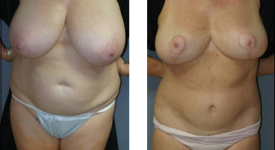 breast_reduction_p3