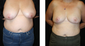 breast_reduction_p4