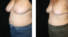 breast_reduction_p4a