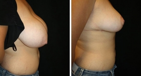 breast_reduction_pt-5-3