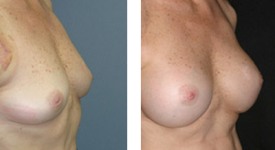 breast_p15b