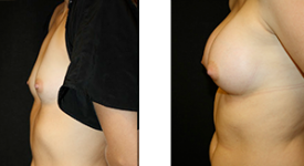 breast_p5b