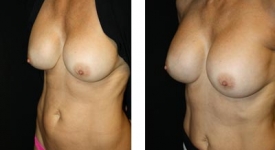 breast_pt-24_1c