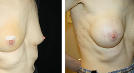 Breast Reconstruction