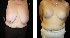 Breast Reconstruction