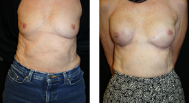 Breast Reconstruction