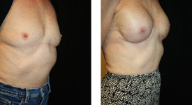 Breast Reconstruction