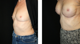 Breast Reconstruction