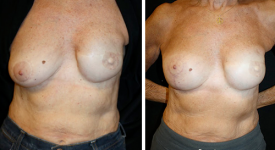 Breast Reconstruction