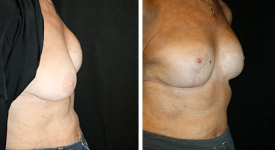 Breast Reconstruction