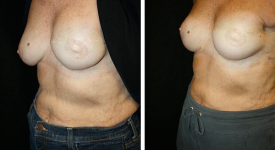 Breast Reconstruction