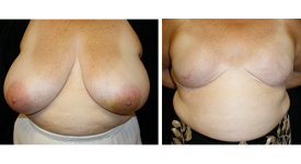 Breast Reconstruction