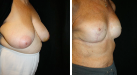 Breast Reconstruction