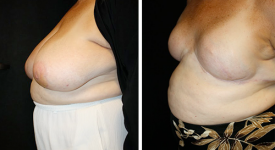 Breast Reconstruction