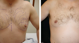 gynecomastia_p1