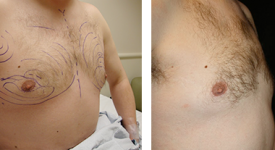 gynecomastia_p1b