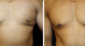 gynecomastia_p2