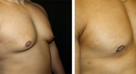 gynecomastia_p2a