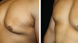 gynecomastia_p2b