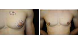 gynecomastia_p3