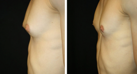 gynecomastia_p3a