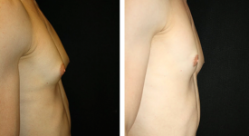 gynecomastia_p3b