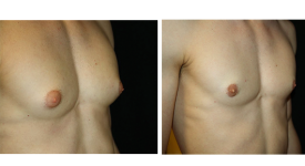 gynecomastia_p3c