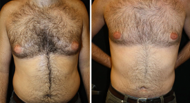 gynecomastia_p4