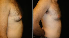 gynecomastia_p4a