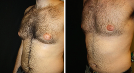 gynecomastia_p4b