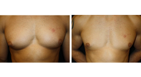 gynecomastia_p5