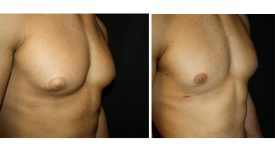 gynecomastia_p5a