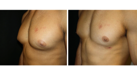 gynecomastia_p5b