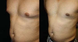 gynecomastia_pt-6-2