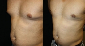 gynecomastia_pt-6-2