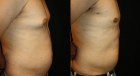 gynecomastia_pt-6-3