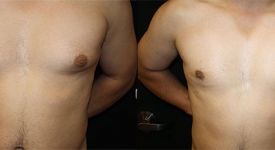 gynecomastia_pt-6