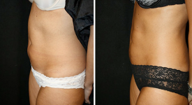 Liposuction_pt2