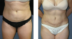 abdominoplasty_p4