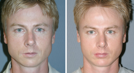 rhinoplasty_p1