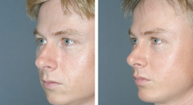 rhinoplasty_p1a