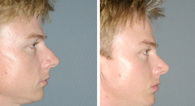 rhinoplasty_p1b