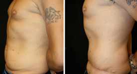 abdominoplasty_p1b