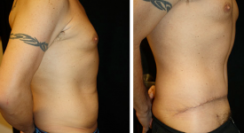 abdominoplasty_p1c