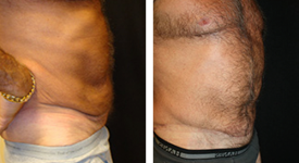 abdominoplasty_p2c